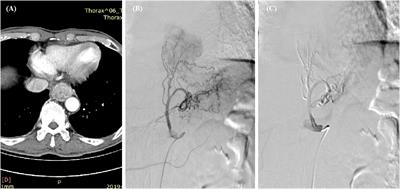 Compression hemostasis using fully covered self-expandable metallic stents for refractory hemorrhages caused by esophageal cancer: A pilot study